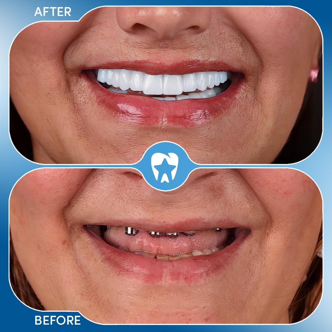 Zirconia Crowns before and after